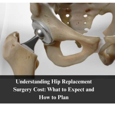 Planning for Joint Replacement Surgery .
